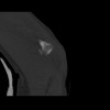 SPORK, NICO - 22.03.1976 - 02.08.2022 - CT obere Extremität - 18:01:46